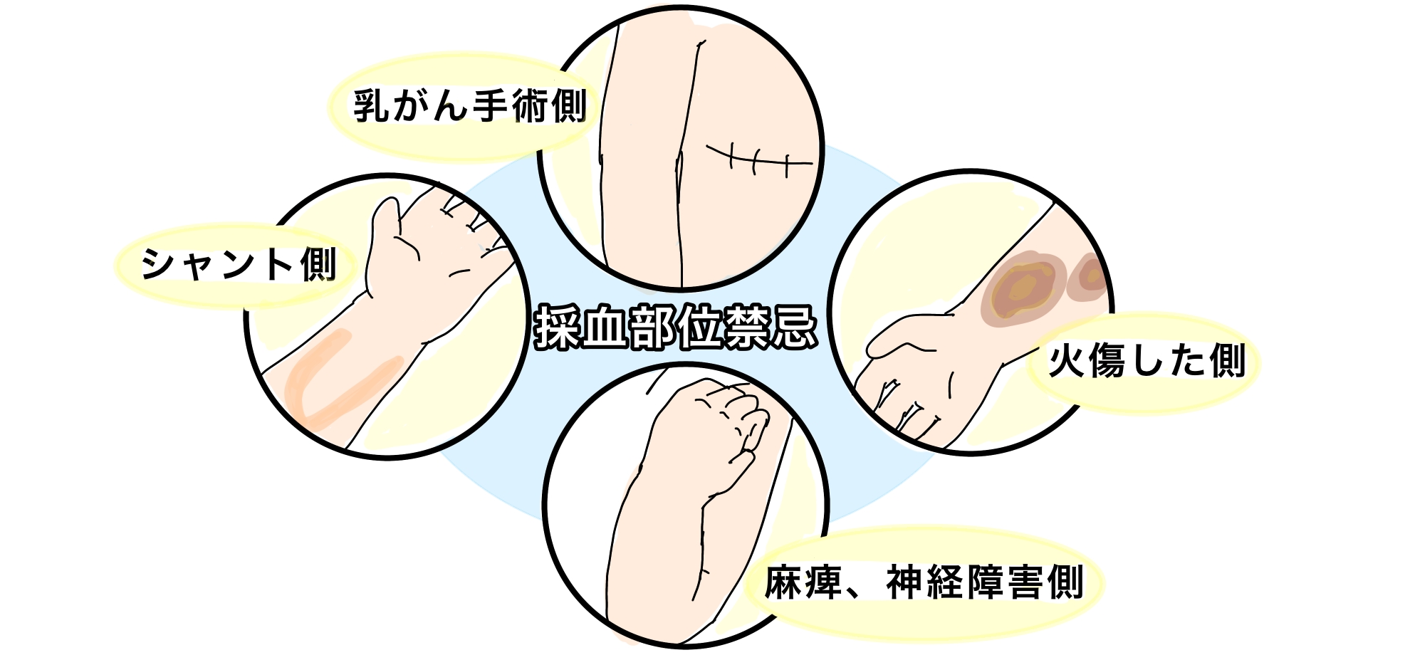 もう迷わない！採血の血管探し方