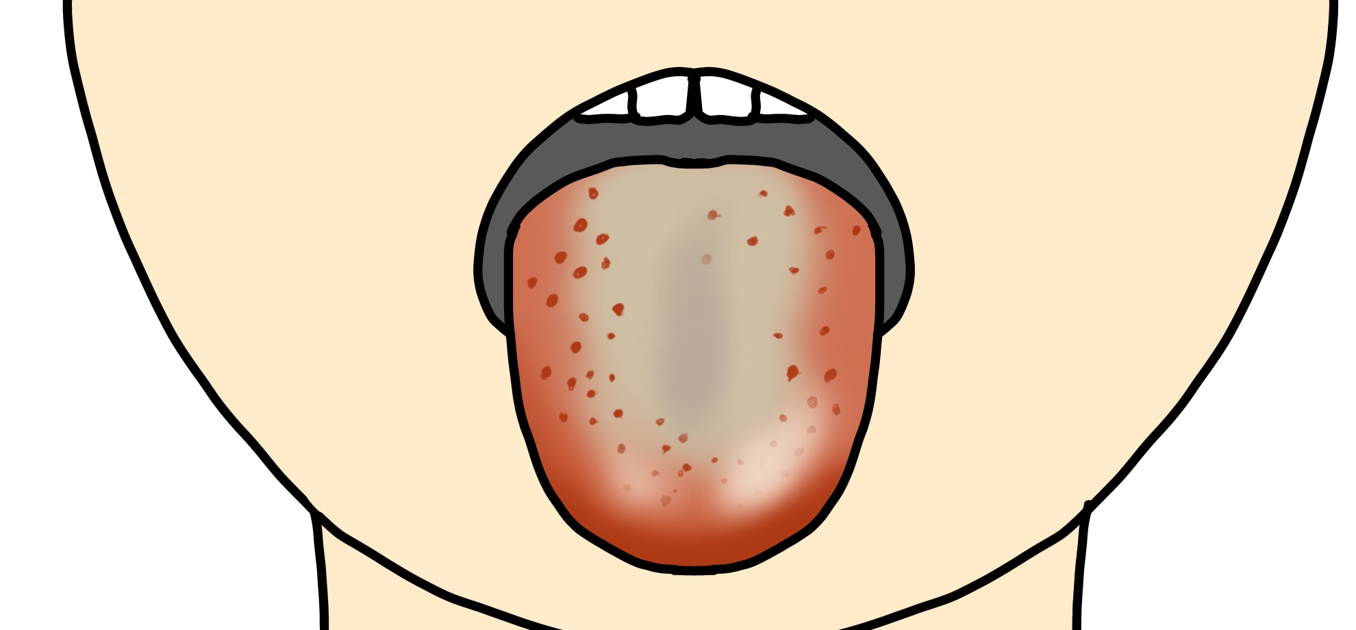 舌苔のある人の口腔ケア