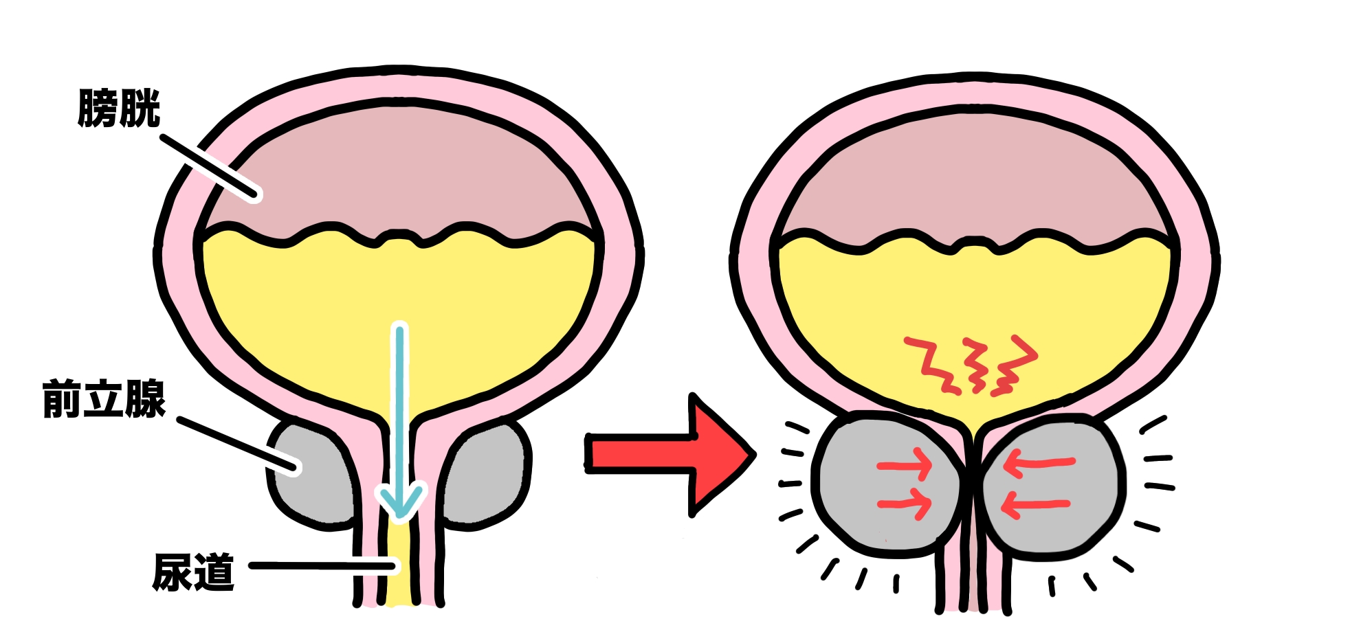 一時的導尿のポイント