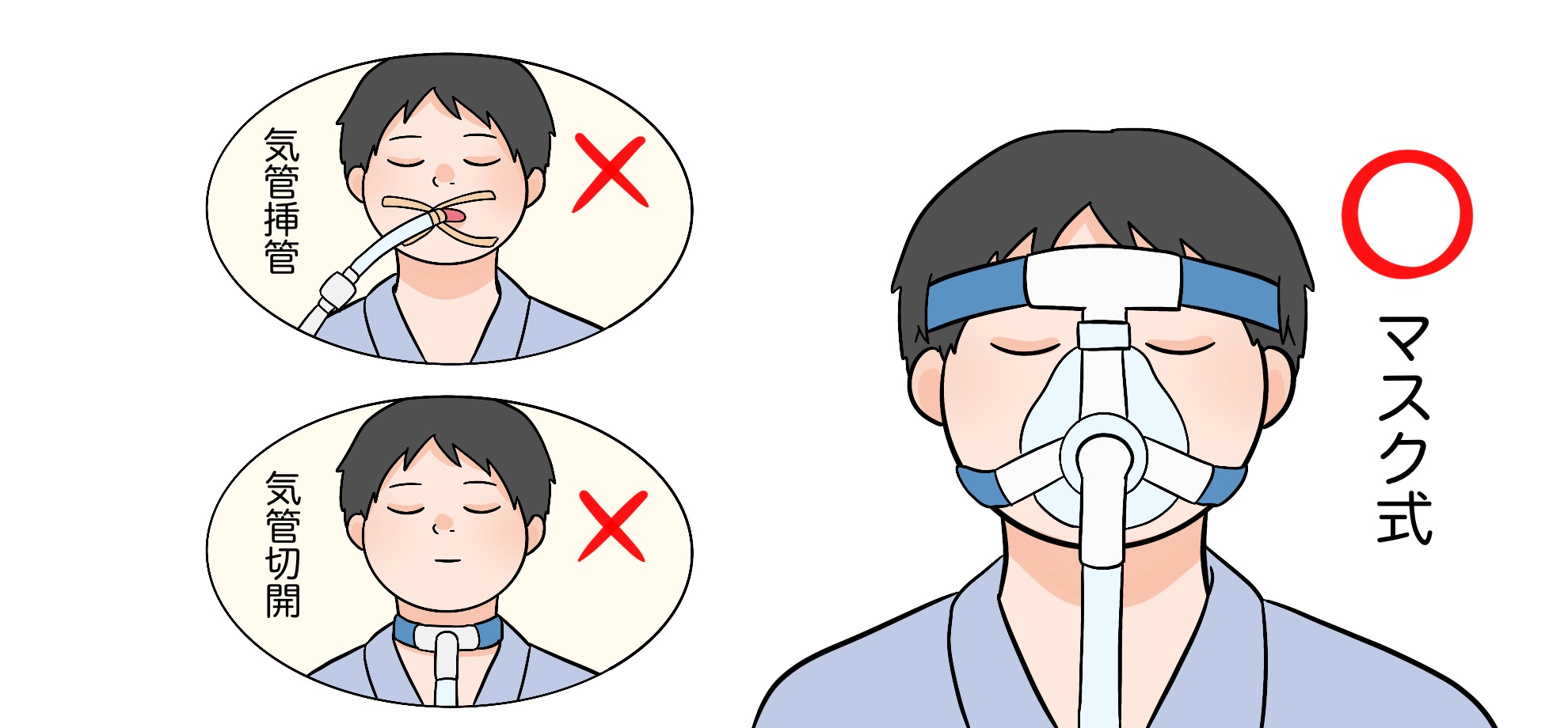 NPPV非侵襲的人工陽圧換気とは